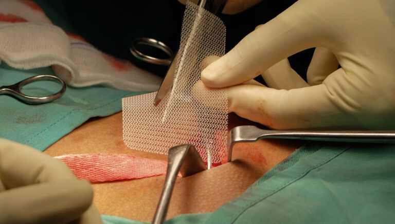 imagem ilustrativa sobre uma cirurgia de hérnia abdominal