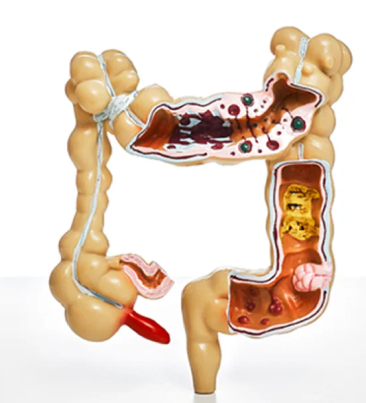 Doença Diverticular  do Cólon