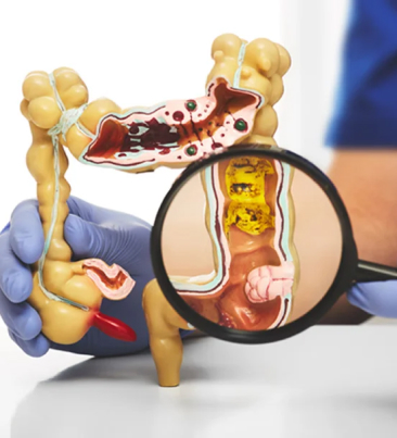 Pólipos do Intestino  e Reto