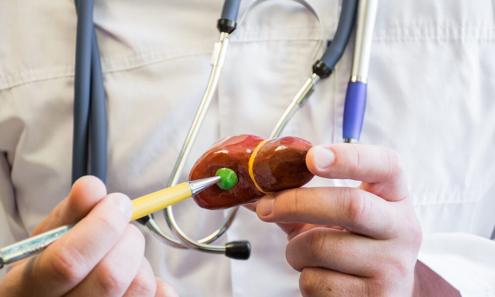 Médico segurando objeto que representa uma vesícula biliar.