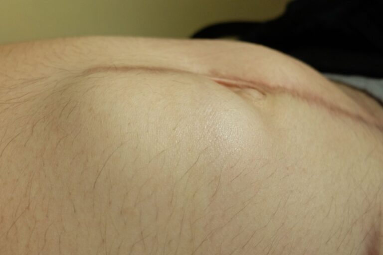 Barriga com um tipo de hérnia abdominal